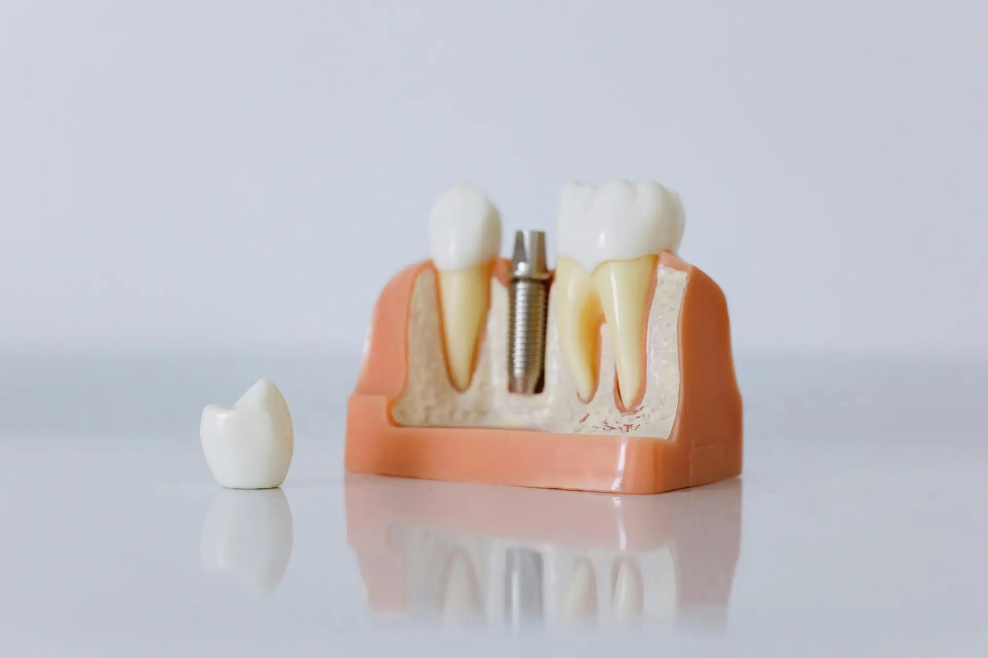 Implante dental cínica odontológica amorós torredembarra implante dental con su tornillo maqueta
